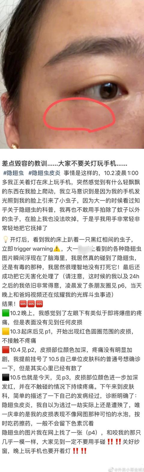 别再关灯玩手机了!网友深夜玩手机差点毁容,背后原因细思极恐